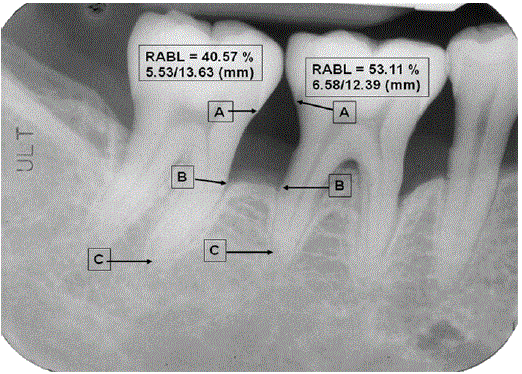 Annually Radiographic Periodontal Bone Loss Rates of Tooth Affected