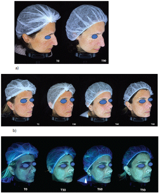 Evaluation of the Efficacy and Safety of A New Pigment Correction ...