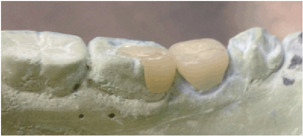 Teaching Students to Fabricate Multiple Adjacent Ceramic Restorations ...
