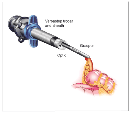 Single Port Laparoscopic Cryptorchidectomy In Dogs And Cats Cases Single Port Laparoscopic Cryptorchidectomy In Dogs And Cats Cases