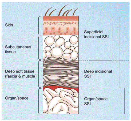 Preventing Surgical Site Infections: A Clinical Perspective